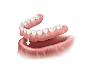 protesi dentaria mobile dentiera