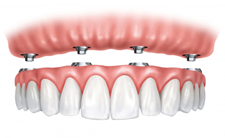 chirurgia-orale-implantologia- dentale - parodontologia
